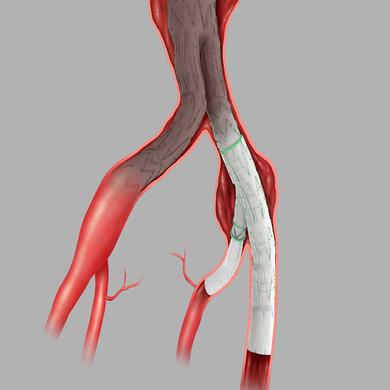 Zenith® Branch Endovascular Graft- Iliac Bifurcation