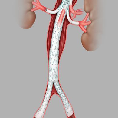 Zenith® Universal Distal Body Endovascular Graft