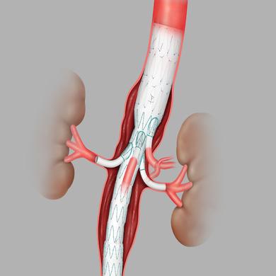 Zenith® t-Branch® Thoracoabdominal Endovascular Graft