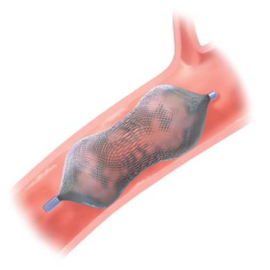 Amplatzer™ Vascular Plug (AVP)