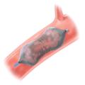 AMPLATZER™ VASCULAR PLUG (AVP)
