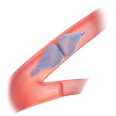 Amplatzer™ Vascular Plug 4  (AVP 4)