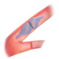 Amplatzer™ Vascular Plug 4 (AVP 4)