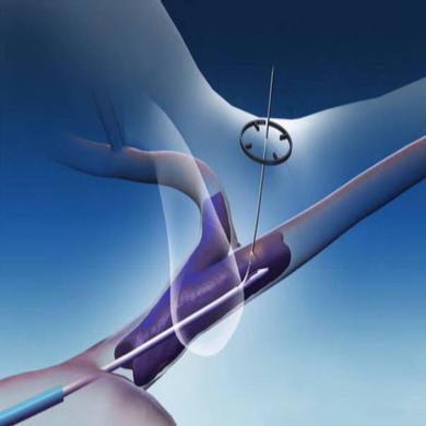 Surfacer® Inside-Out® Access Catheter System